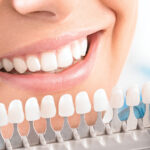 veneers in dubai 7
