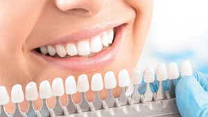 Are Veneers in Dubai Worth It? Full Guide 1 Are Veneers in Dubai Worth It? Full Guide