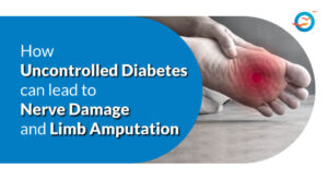 How Uncontrolled Diabetes Can Lead to Nerve Damage and Limb Amputation