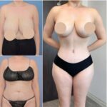 Achieve a Balanced Silhouette with Tummy Tuck in Dubai