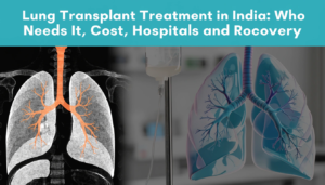 Lung Transplant Treatment in India: Who Needs It, Cost, Hospitals and Recovery