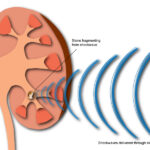 Shock Wave Lithotripsy 1