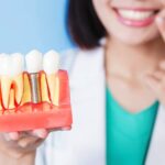 Dental Implants in Dubai 5