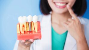 Hidden Dental Implant Cost In Dubai You Should Know