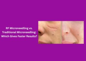 RF Microneedling vs. Traditional Microneedling: Which Gives Faster Results? 1 RF Microneedling vs. Traditional Microneedling: Which Gives Faster Results?