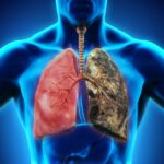 Early vs. Advanced Small Cell Lung Cancer: Treatment Differences Explained