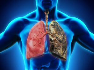 Early vs. Advanced Small Cell Lung Cancer: Treatment Differences Explained