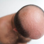 Hybrid Hair Transplant in Dubai9