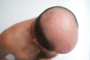 What are the side effects of hair transplant procedure