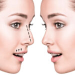 Non-Surgical Rhinoplasty Treatment: What to Expect