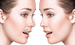 Non-Surgical Rhinoplasty Treatment: What to Expect
