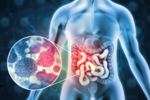 Best Colon Cancer Treatment in Nagpur by Dr. Sameeksha Dubey for Patients Today
