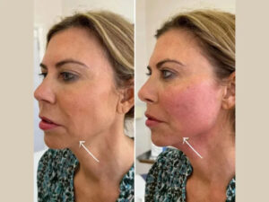 Best Plastic Surgeons in dubai Specializing in Endolift Face Sculpting