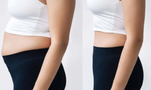 Do Fat Melting Injections deliver visible fat loss without effort?