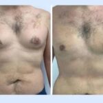 Gynecomastia in Dubai: Why Accreditation and Clinic Standards Matter 3 Gynecomastia in Dubai: Why Accreditation and Clinic Standards Matter