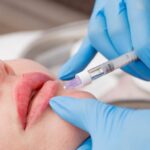 Juvederm Filler in Dubai11