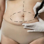 tummy tuck in Dubai