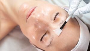 Can Chemical Peels Clear Acne-Prone Skin Fast?