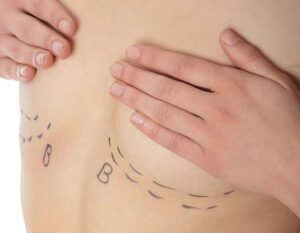 Can Breast Lift Surgery Correct Asymmetrical Shape?
