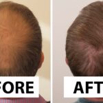 From Thinning to Thriving: Why Beauté Concept Is Setting the Gold Standard for Hair Transplant in Dubai
