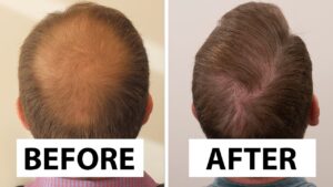 From Thinning to Thriving: Why Beauté Concept Is Setting the Gold Standard for Hair Transplant in Dubai