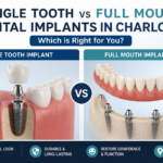 Single Tooth vs Full Mouth Dental Implants in Charlotte Which is Right for You