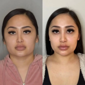 Why Millennials Are Choosing Buccal fat removal Surgery in Dubai