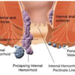 Minimally Invasive Hemorrhoid Embolization in Toronto