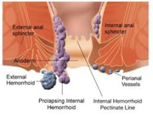Minimally Invasive Hemorrhoid Embolization in Toronto