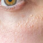 Milia treatment in Dubai22