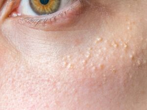 Can Milia Treatment Be Customized for Every Skin?