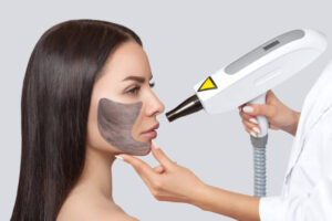 How Q-Switched Laser Transforms Pigmented Skin Lesions Effortlessly