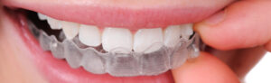 Smile Confidently with Invisible Braces