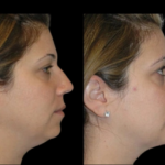 Key Benefits of Advanced Double chin removal Surgery in dubai Procedures