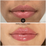 Copy of lip filler 6
