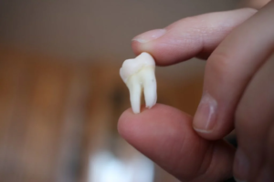 Wisdom Tooth Removal Treatment Cost and Recovery Timeline