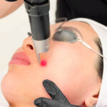 PicoSure Laser Treatment for Skin Confidence Boost