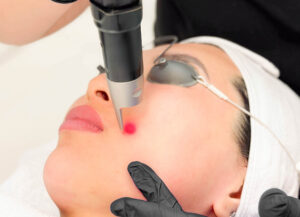 PicoSure Laser Treatment for Skin Confidence Boost