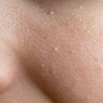 Is Milia Removal Painful or Comfortable for Patients?