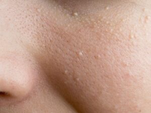 Is Milia Removal Painful or Comfortable for Patients?