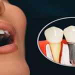Dental Implant resize
