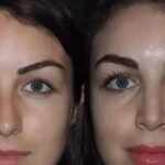 Rhinoplasty in Dubai for Personalized Beauty Goals 4 Rhinoplasty in Dubai for Personalized Beauty Goals
