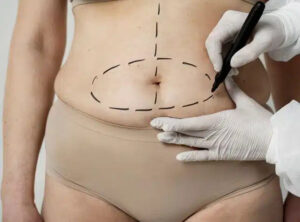 How to Sleep After Tummy Tuck in Dubai Surgery 1 How to Sleep After Tummy Tuck in Dubai Surgery