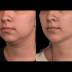 Chin liposuction 5 1