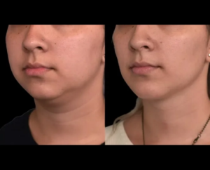 How Lifestyle Changes Enhance Double chin removal Surgery in dubai Results