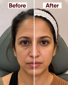 Best Sculptra Treatment in Delhi | Dr. Neha Batra Clinic