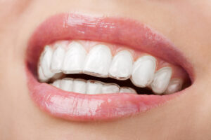Traditional Braces vs Clear Aligners – Which Is Better? 1 Traditional Braces vs Clear Aligners – Which Is Better?