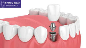 Common Dental Problems in Children and Pediatric Treatment Approaches