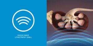 Benefits of Shock Wave Lithotripsy for Kidney Stones