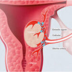 fibroids uterine artery embolization